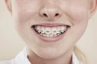 Definition & pronunciation of brace